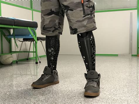 3D Printed Prosthetic