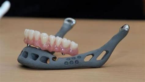 3D printable implant model