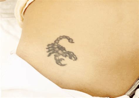 Anchorage Tattoo Removal Costs