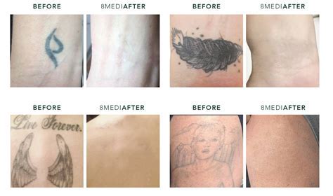 Benefits of Tattoo Removal