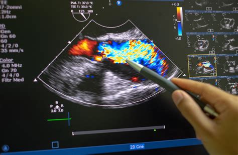 Cardiovascular Sonography Images