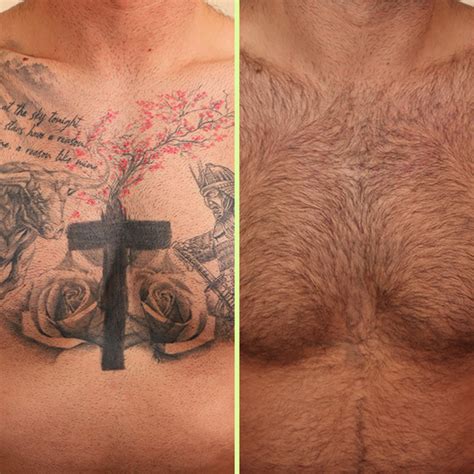 Chest tattoo removal and correction