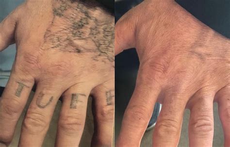 Choosing a Tattoo Removal Expert