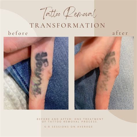 Tattoo Removal in Clarksville Tn