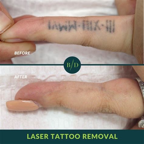 Laser Tattoo Removal