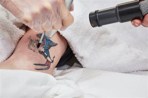 Laser Tattoo Removal