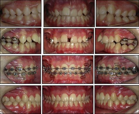 Medically Necessary Orthodontic Treatment