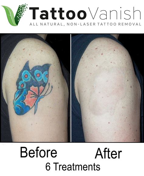 Non-Laser Tattoo Removal