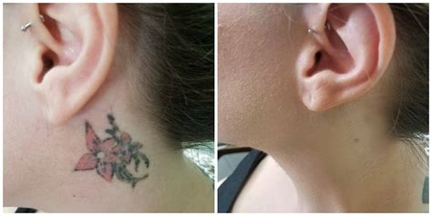 Tattoo Correction