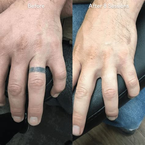 Tattoo Removal Before