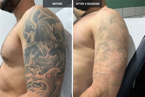 Tattoo Removal Before and After