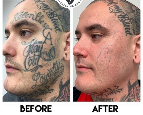 Tattoo Removal Before and After Pictures