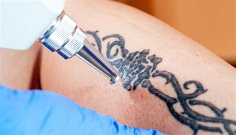 Tattoo Removal Benefits