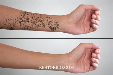 Tattoo Removal Expectations