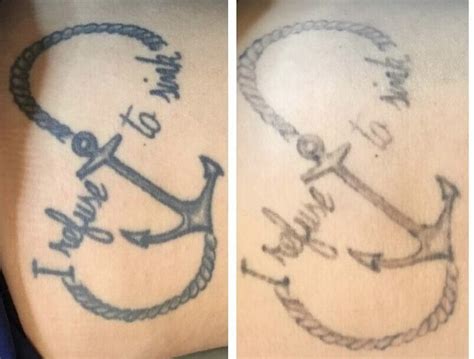 Tattoo Removal in North Myrtle Beach