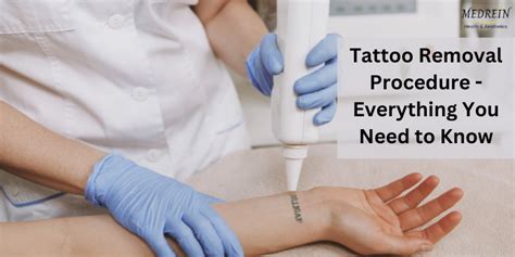 Tattoo Removal Procedure