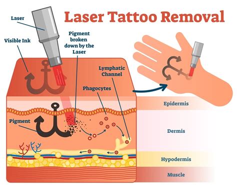 Tattoo Removal Process Image 5