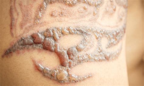 Tattoo Removal Risks