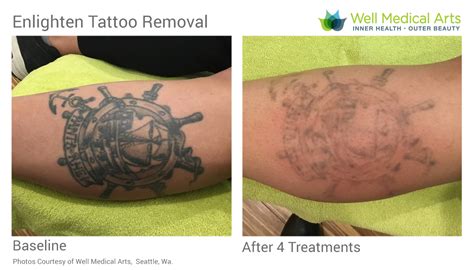 Tattoo Removal Testimonials