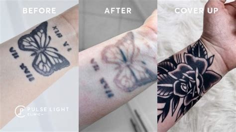 Tattoo Removal and Cover-Up