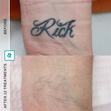 Tattoo Removal and Cover-Ups