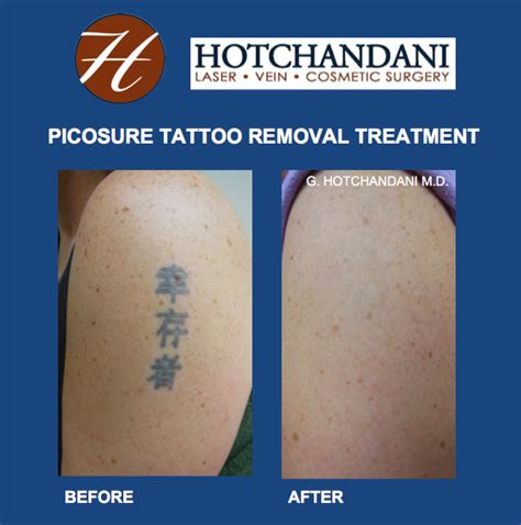 Tattoo Removal in Green Bay