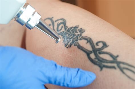 Tattoo Removal in New Haven