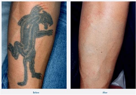 Tattoo Removal in New Haven