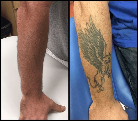 Tattoo Removal in Richmond Ky