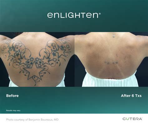 Tulsa Tattoo Removal Experts Reviews