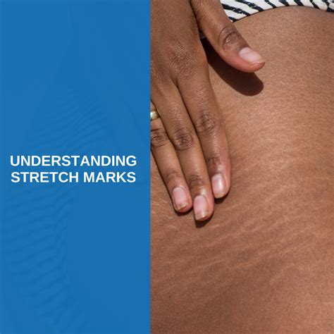 Understanding Stretch Marks