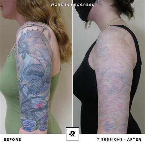 Upper Arm Tattoo Removal