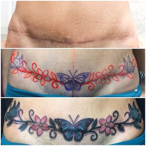 Description of Abdominoplasty Scar Tattoos