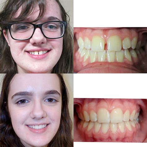 affordable orthodontic treatments gallery