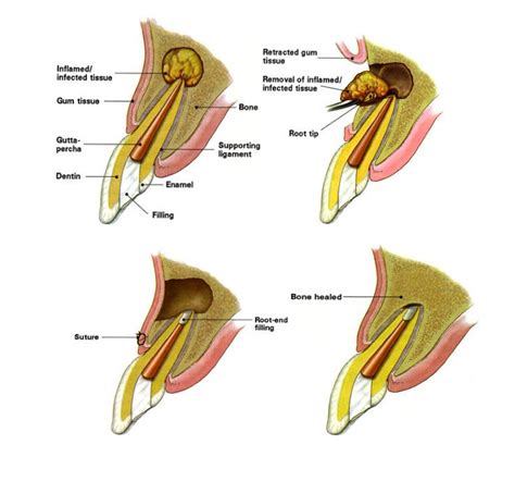 Apicoectomy