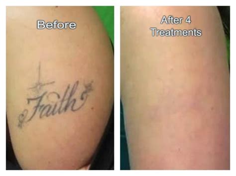 Benefits of laser tattoo removal