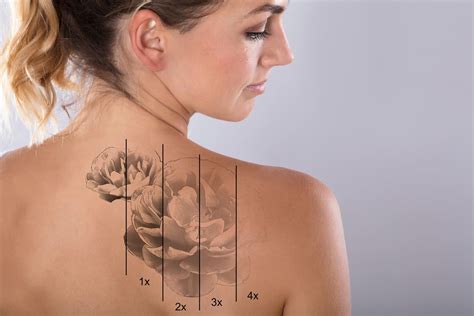 Benefits of Tattoo Removal