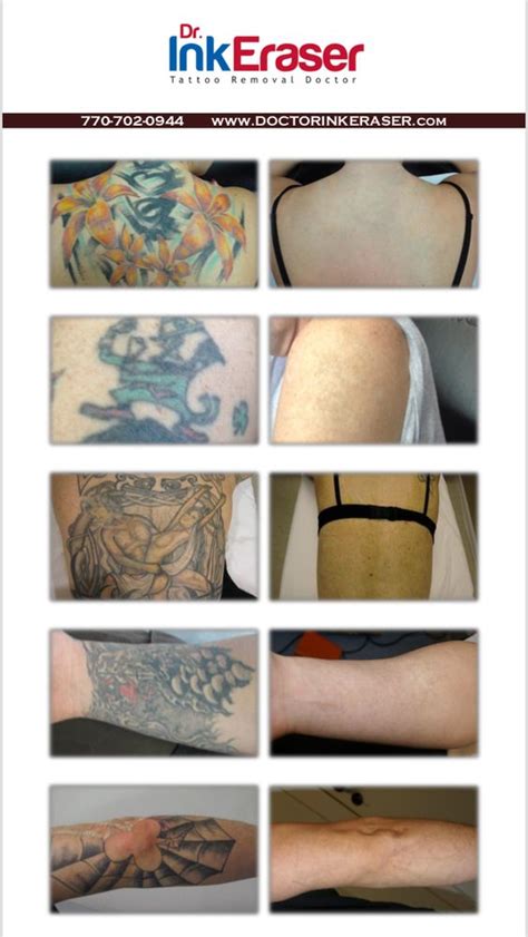 Birmingham AL Tattoo Removal Experts