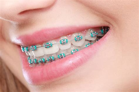 braces cost gallery