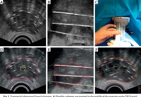 Brachytherapy