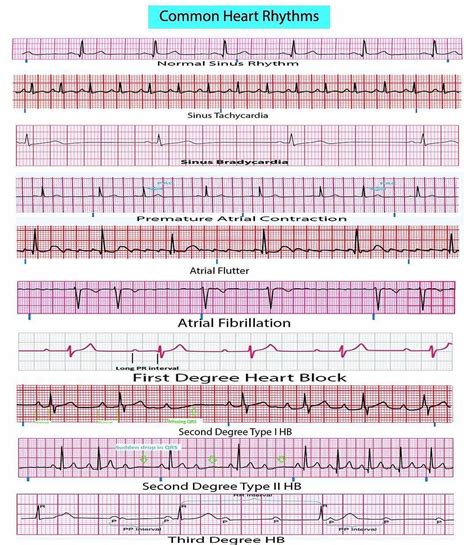 Cardiac Arrhythmias