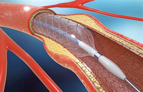 Cardiac Catheterization