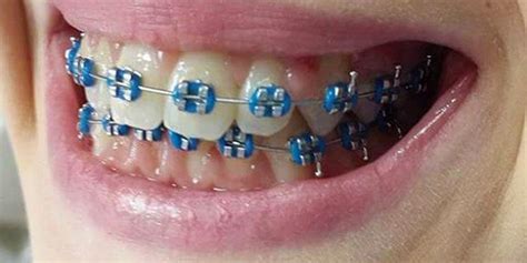 Ceramic Navy Blue Braces