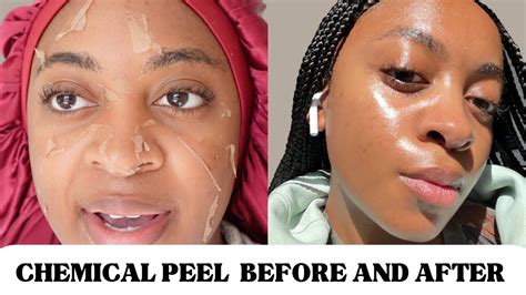 Chemical peels method