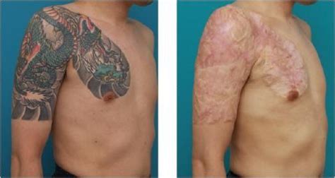 Chemical peels for tattoo fading