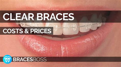 clear braces cost