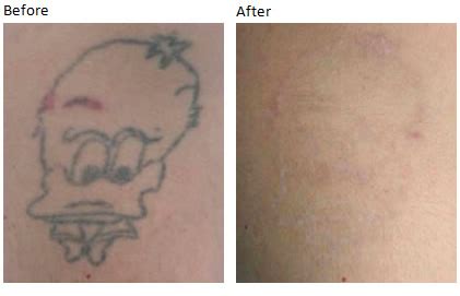 Practical examples of Clearit tattoo removal