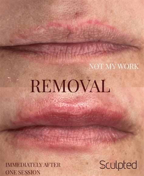 Cosmetic Tattoo Removal