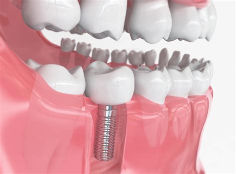 Dental Implants