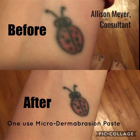 Dermabrasion for Tattoo Removal